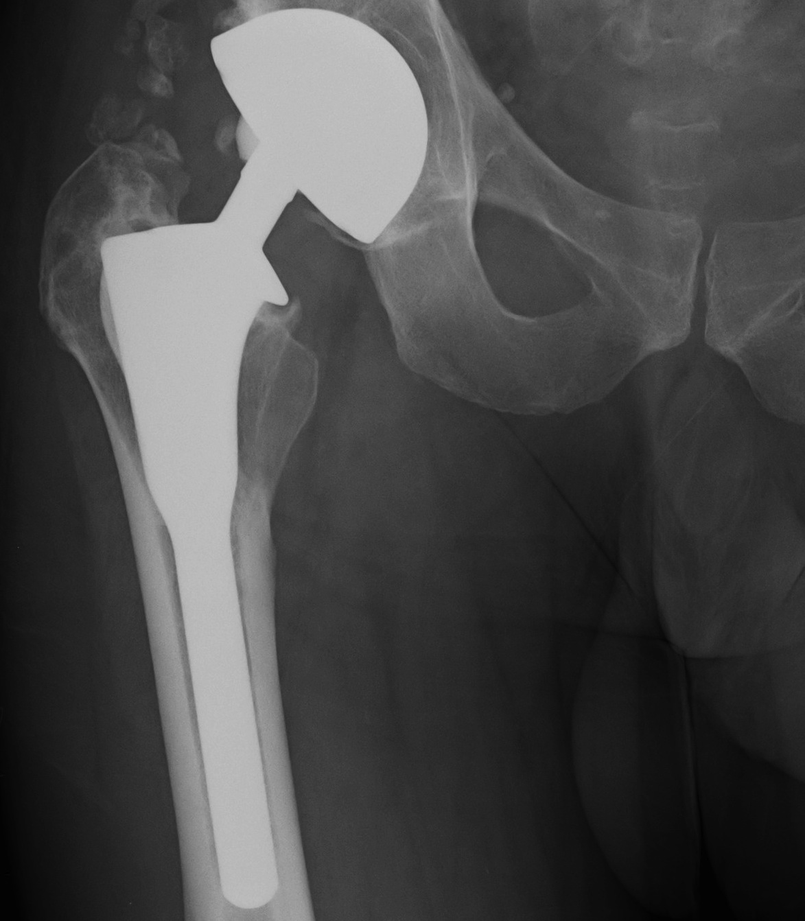 THR Uncemented Proximal Stress Shielding